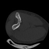SPORK, NICO - 22.03.1976 - 02.08.2022 - CT obere Extremität - 17:51:17